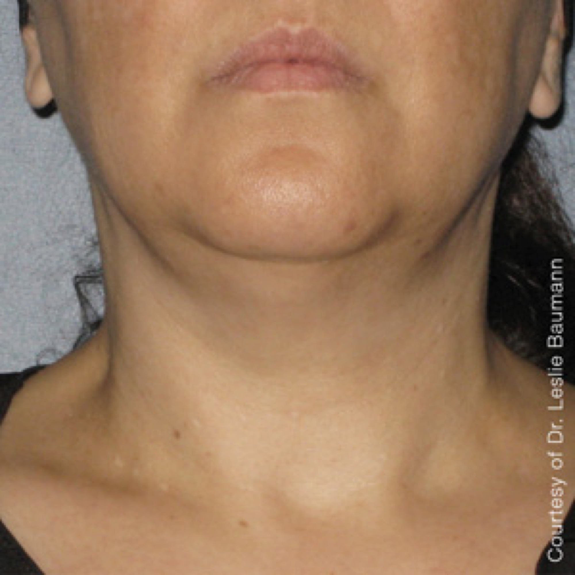 Ultherapy-0014-0086W_90Day_1TX_AFTER_Neck_low-res
